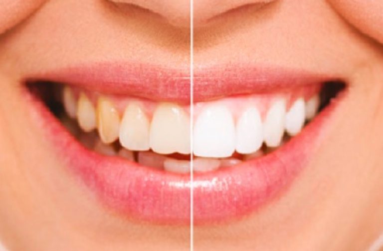 Wybielanie zębów - Łomża - Stomatologia Poznalscy